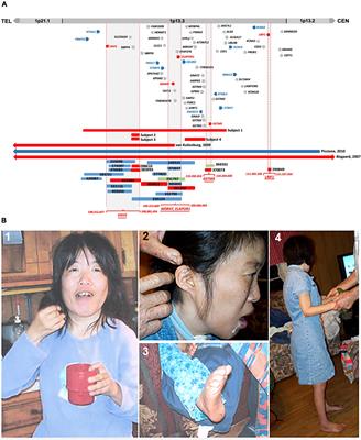 A rigorous in silico genomic interrogation at 1p13.3 reveals 16 autosomal dominant candidate genes in syndromic neurodevelopmental disorders